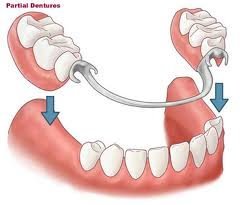 Removable Partial Dentures With Superior Restoration Effect For Partial Denture Case