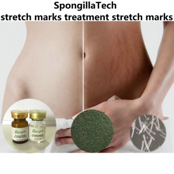 Get rid of stretch marks | Spicule treatment to remove stretch marks