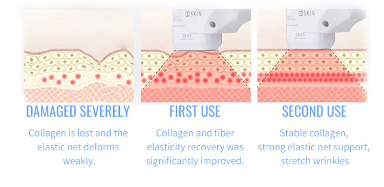 Hifu Ultherapy Hifu Ultherapy