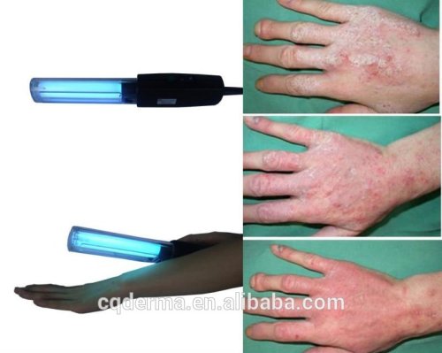 UV psoriasis treatment -uv phototherapy lamp for psoriasis