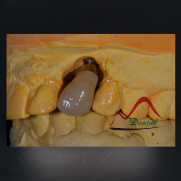 Co-Cr PFM Crown and Bridge on Implant