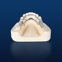 Bego Metal Partial Denture