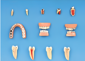 Dental Diseases Model (as an educational tool)