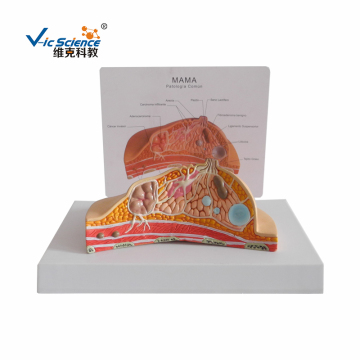 Pathological anatomy model of breast