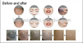 ND yag laser removal machine tattoo pour maquillage permanent