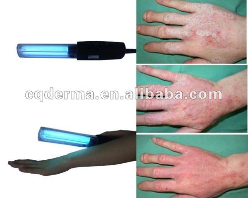 Eczema Cure Medical Lamps- Psoriasis, Vitiligo, Eczema, Atopic Dermatitis