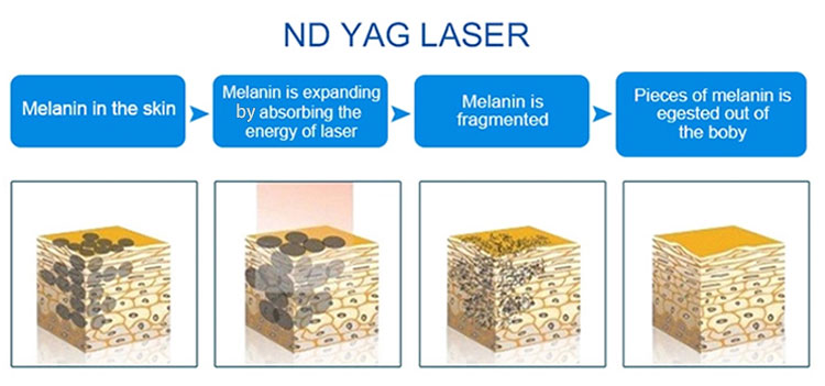 Nd Yag Laser Nd Yag Laser