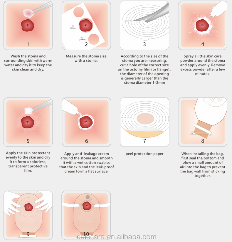 Stoma Ostomy Pouching System Disposable Drainable Ostomy Pouch