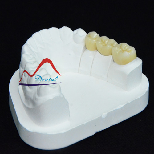 Full contour zirconia bridges