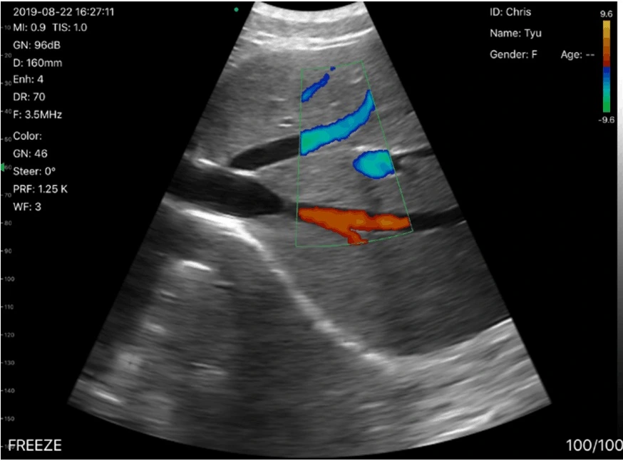 Wireless Ultrasound 3 in Probe Wireless Ultrasound Portable Mini 5g Wireless Ultrasound Scan Probe