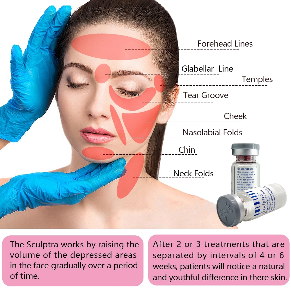 Wrinkles-Removal-Injectable-Sculptra-Plla-Poly-L-Lactic-Acid-for-Face-Body.webp (9)