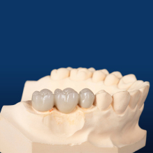 IPS Emax CAD/CAM Restorations