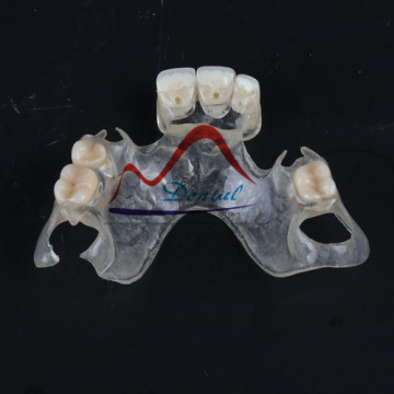 Dental Clear Flexible Partial Removable Denture