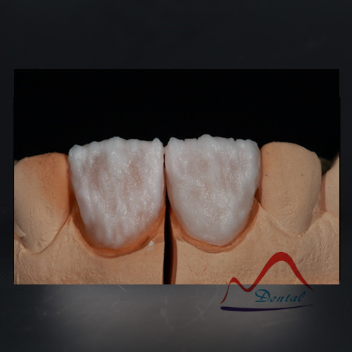 Emax veneer  (3)