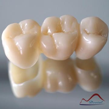 3Shape Full Contour Zirconia Bridge