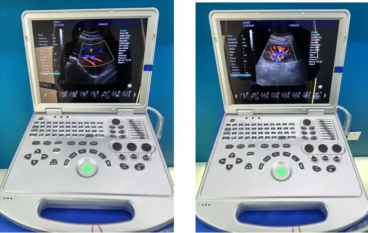 Portable 4D Color Doppler Ultrasound Scanner