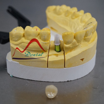 Zirconia Crown and Bridge on Implant