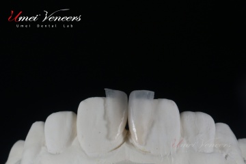 Ultra thin Hollywood veneers