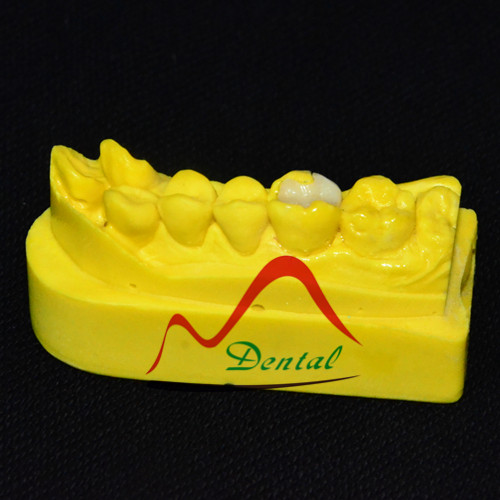 Dental emax inlay2