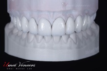 Super Natural Hollywood Veneers