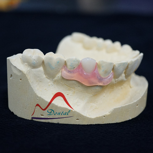 Dental Valplast unilateral partial denture