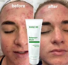 2024 Hot Sale Balance Cream Mask for All Skin Types - Nourish, Anti-Acne, Multi-Functional