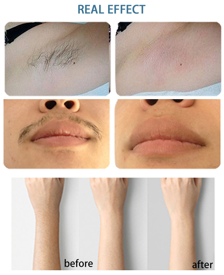 808 Nm Laser Hair Removal