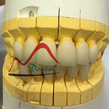 Zirconia Crown Withstanding Biting Pressure