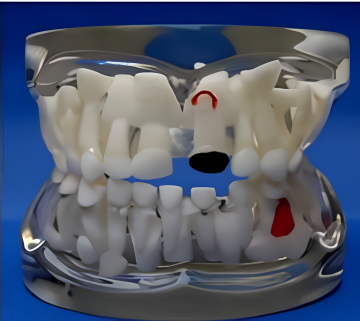 Transparent Milk Teeth Pathology Model