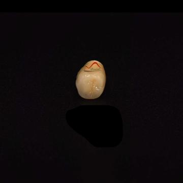 Cement Retained Cocr Implant