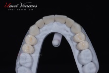 Strong zirconium oxide veneers