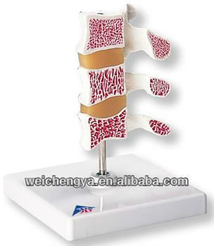 Cutaway Osteoporosis Model