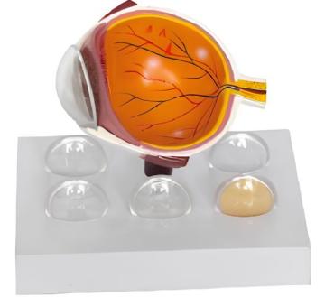 Glaucoma model