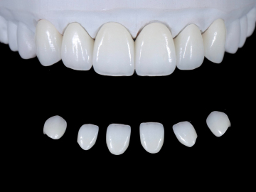 Ultra-simulated dental zirconia aesthetic veneers