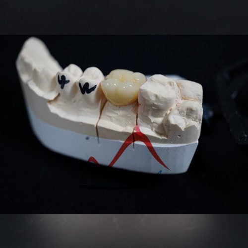 Outstanding marginal fit Zirconia crown and bridge