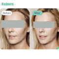 Stimulate Collagen Produce Dermal Filler