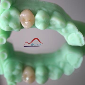 Dental 3D E-max Crown