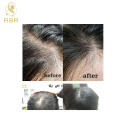 Inno-TDS Hair Loss Promote The Growth Hair Loss Control Treatment