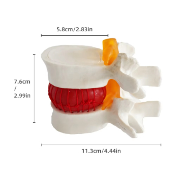 Lumbar Disc Herniation Model FRT039 - Human Lumbar Vertebral Spine Anatomic Model