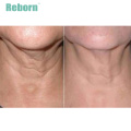 Anti Wrinkle Injection PLLA Dermal Filler For Youthful Neck