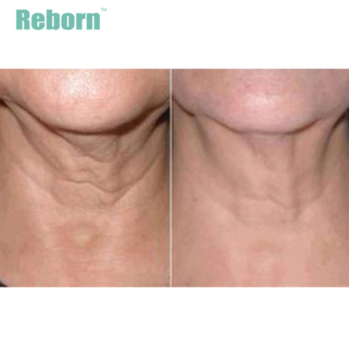 Mesotherapy PLLA Gel Wrinkles Removel For Youthful Neck