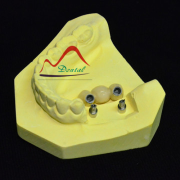 PFM Implant Alternative for Denture and Bridge