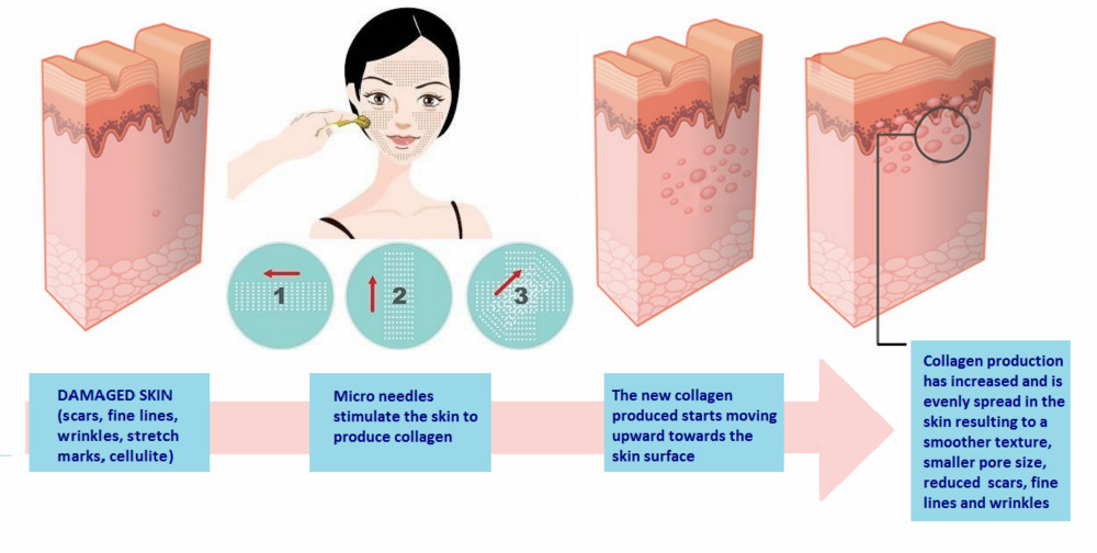 derma roller system derma roller system
