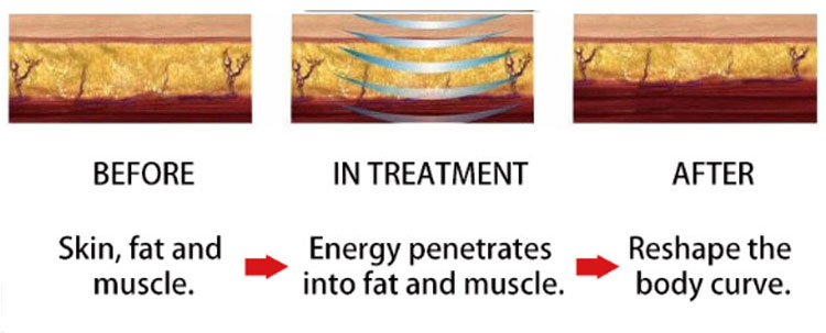 Portable Emsculpt Equipment