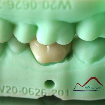 3Shape Posterior Full Contour Zirconia Crown