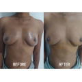 Natural Filling Results Long-lasting Safe Breast Booster