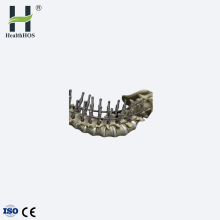 Plat fiksasi Titanium Posterior Vertebrae serviks