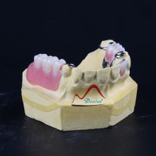 CoCr Casting Framework Partial