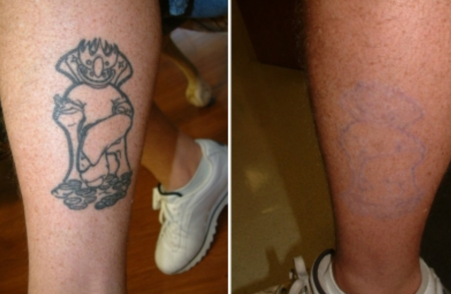Remoção de tatuagem a laser Choicy Remoção de tatuagem de picossegundos