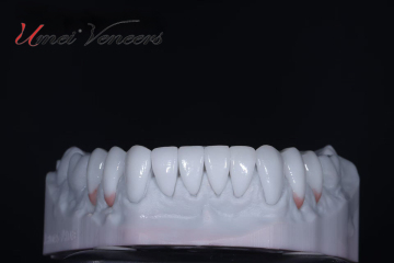 Ultra-thin zirconia veneers